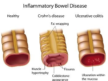 Curcumin for IBD Patients