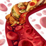5 Ways Curcumin Helps in Tackling High Cholesterol … The natural way to avoid a heart attack
